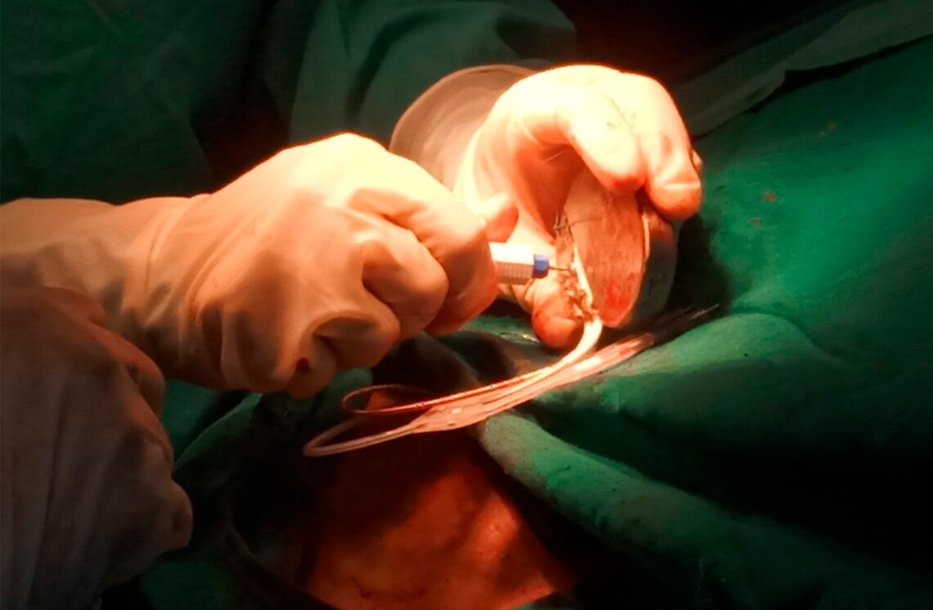 Primera_Cirugía_Cardiovascular_en_Pinar_del_Río (4)